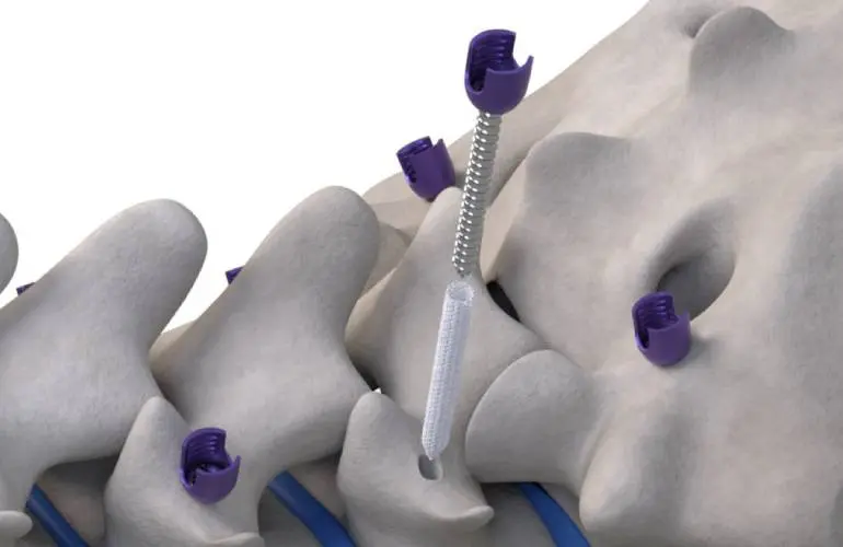 Woven Orthopedic Technologies手术螺钉增强器获FDA认证