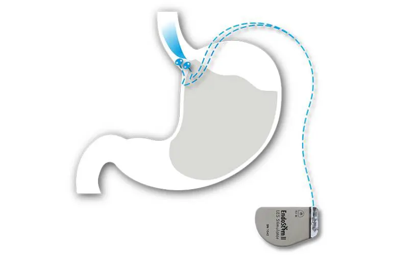EndoStim日前获FDA突破性认证,用于治疗难治性GERD