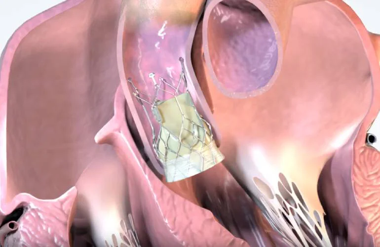 Onecrea Medical完成TAVR系统首例人体植入手术