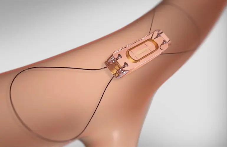 研究称Abbott CardioMEMS监测技术可提高心力衰竭患者生存率