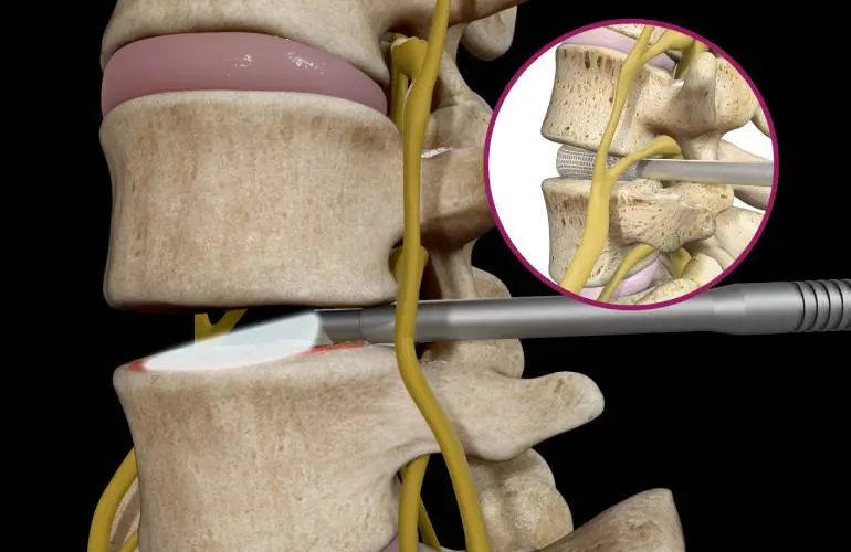 Spineology推出全腔镜椎间融合系统