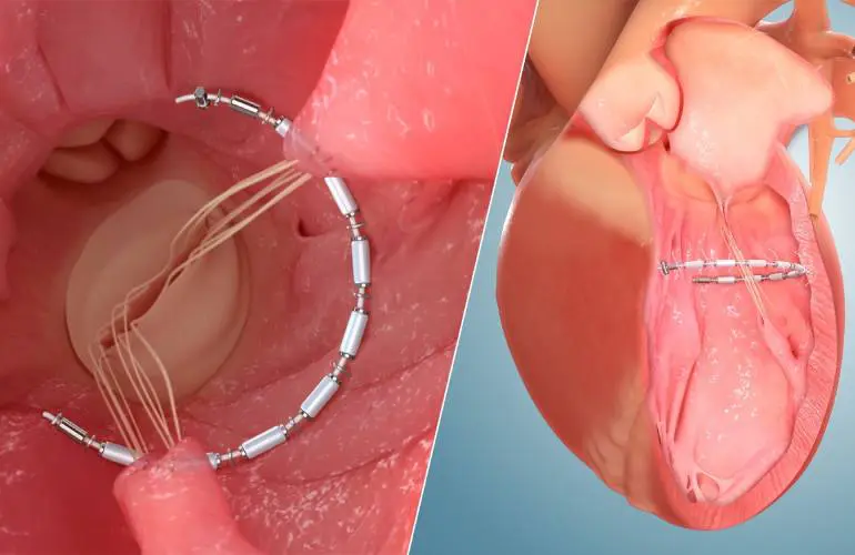 Ancora Heart AccuCinch系统改善心力衰竭患者预后