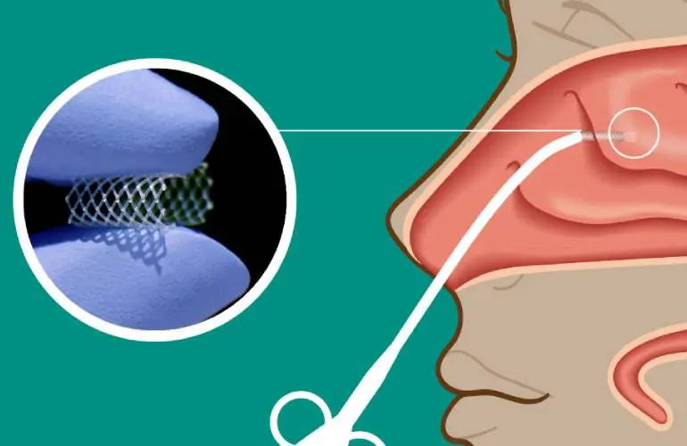 Lyra Therapeutics入组第一名慢性鼻窦炎患者进行三期临床试验