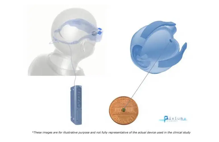 Pixium Vision获得FDA突破性设备认可以治疗干性AMD的设备