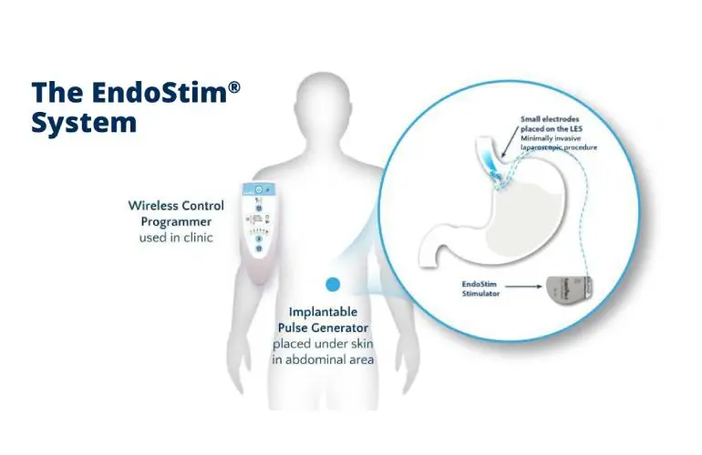 EndoStim为治疗GERD的神经刺激植入装置准备FDA PMA申报